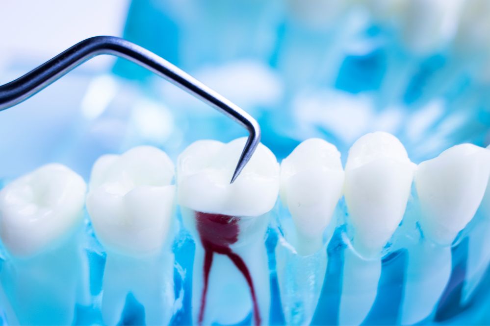 Clínica Dental para Endodoncia Cerca de Mi