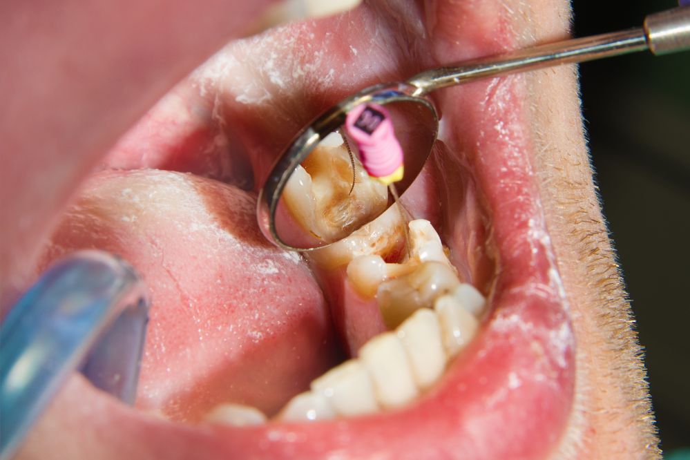 Clínica Dental Tratamiento de Endodoncia Cerca de Mi